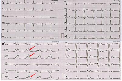 Case report: Pacemaker lost capture after acute myocardial infarction in a patient with left circumflex coronary artery occlusion